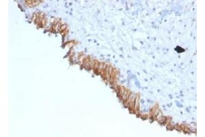 IHC testing of FFPE human bladder carcinoma with MAML2 antibody (clone MAML2/1302). (MAML2 抗体)