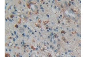 Detection of GSN in Human Glioma Tissue using Polyclonal Antibody to Gelsolin (GSN) (Gelsolin 抗体  (AA 577-771))