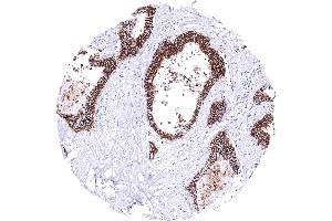 Colon Colorectal adenocarcinoma with strong CDH17 immunostaining of all tumor cells CDH17 immunohistochemistry (LI Cadherin 抗体  (AA 242-418))