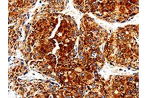The image is immunohistochemistry of paraffin-embedded Human liver cancer tissue using ABIN7129012(COX19 Antibody) at dilution 1/50. (COX19 抗体)