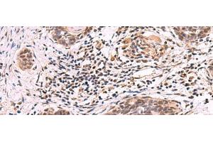 Immunohistochemistry of paraffin-embedded Human esophagus cancer tissue using ARIH2 Polyclonal Antibody at dilution of 1:80(x200) (ARIH2 抗体)
