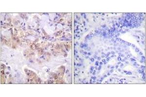 Immunohistochemistry analysis of paraffin-embedded human lung carcinoma, using C-RAF (Phospho-Ser621) Antibody. (RAF1 抗体  (pTyr621))
