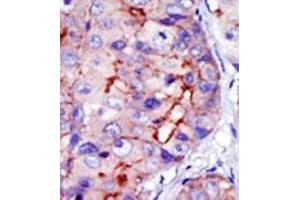 Formalin-fixed and paraffin-embedded human cancer tissue (hepatocarcinoma) reacted with the primary antibody, which was peroxidase-conjugated to the secondary antibody, followed by DAB staining. (CAMK1D 抗体  (C-Term))