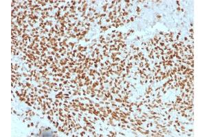 Formalin-fixed, paraffin-embedded human Ewing's Sarcoma stained with NKX2. (Nkx2-2 抗体  (AA 1-119))