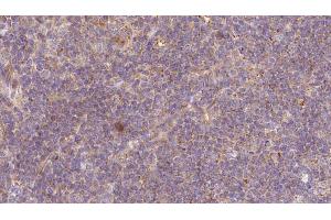 ABIN6273177 at 1/100 staining Human lymph cancer tissue by IHC-P. (Tropomodulin 1 抗体  (N-Term))