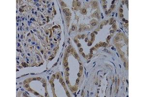 Immunohistochemistry of paraffin-embedded Human kidney cancer using WDR5 Polyclonal Antibody at dilution of 1:200 (40x lens). (WDR5 抗体)