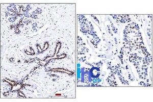 Formalin-fixed, paraffin-embedded normal human breast (left) and invasive ductal carcinoma (right) stained with progesterone receptor Ab (PR501). (Progesterone Receptor 抗体)