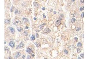Immunohistochemical staining of formalin-fixed paraffin-embedded human liver tissue showing membrane staining with AKR1A1 polyclonal antibody  at 1 : 100 dilution. (AKR1A1 抗体  (AA 132-310))