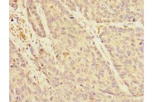 Immunohistochemistry of paraffin-embedded human ovarian cancer using ABIN7167162 at dilution of 1:100 (IQGAP3 抗体  (AA 1437-1631))
