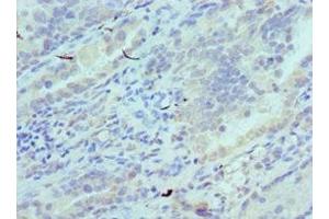Immunohistochemistry of paraffin-embedded human lung cancer using ABIN7147246 at dilution of 1:100 (CADM1 抗体  (AA 45-344))