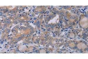 Immunohistochemistry of paraffin-embedded Human thyroid cancer using P2RX3 Polyclonal Antibody at dilution of 1:50 (P2RX3 抗体)