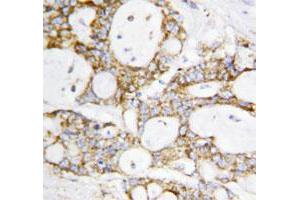 Immunohistochemical staining of paraffin embedded human breast cancer tissue section with DLD polyclonal antibody . (DLD 抗体  (C-Term))