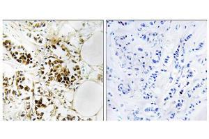 Immunohistochemistry analysis of paraffin-embedded human breast carcinoma tissue, using RGS5 antibody. (RGS5 抗体  (Internal Region))