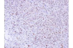 IHC-P Image Immunohistochemical analysis of paraffin-embedded H1299 Xenograft , using NGFRAP1, antibody at 1:100 dilution. (Nerve Growth Factor Receptor (TNFRSF16) Associated Protein 1 (NGFRAP1) (Center) 抗体)
