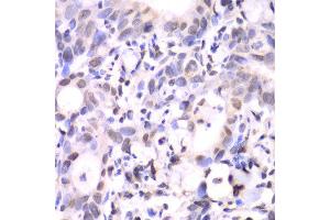 Immunohistochemistry of paraffin-embedded human gastric cancer using HAT1 antibody at dilution of 1:100 (x40 lens). (HAT1 抗体)