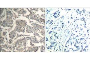 Immunohistochemical analysis of paraffin-embedded human breast carcinoma tissue using cofilin1/cofilin2 (Ab -88) Antibody (E021507). (Cofilin1/2 (CFL1/2) 抗体)