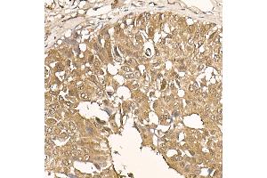 Immunohistochemistry of paraffin-embedded human breast cancer using [KO Validated]  Rabbit mAb (ABIN7271243) at dilution of 1:100 (40x lens). (AKT1 抗体)