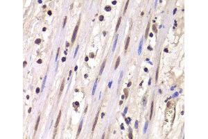 Immunohistochemistry of paraffin-embedded Human mammary cancer using LSM4 Polyclonal Antibody at dilution of 1:100 (40x lens). (LSM4 抗体)
