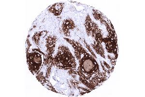 Strong Cytokeratin 10 immunostaining in a squamous cell carcinoma of the vulva. (Recombinant Keratin 10 抗体)