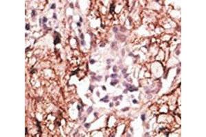 IHC analysis of FFPE human breast carcinoma tissue stained with the LSD1 antibody (LSD1 抗体  (AA 108-142))