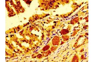 Immunohistochemistry of paraffin-embedded human prostate cancer using ABIN7147000 at dilution of 1:100 (Cathepsin D 抗体  (AA 67-403))