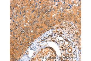 Immunohistochemistry of Human colon cancer using ACOX3 Polyclonal Antibody at dilution of 1:35 (ACOX3 抗体)