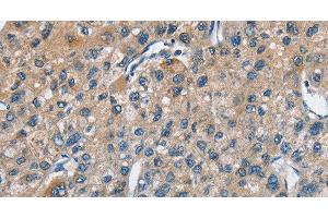 Immunohistochemistry of paraffin-embedded Human liver cancer using TRIP4 Polyclonal Antibody at dilution of 1:50 (TRIP4 抗体)