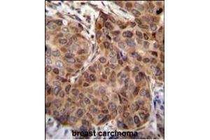 SNX24 Antibody (N-term) (ABIN655522 and ABIN2845036) immunohistochemistry analysis in formalin fixed and paraffin embedded human breast carcinoma followed by peroxidase conjugation of the secondary antibody and DAB staining.