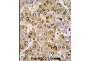 Formalin-fixed and paraffin-embedded human hepatocarcinoma tissue reacted with DDX5 antibody , which was peroxidase-conjugated to the secondary antibody, followed by DAB staining. (DDX5 抗体  (C-Term))
