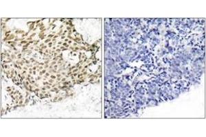 Immunohistochemistry analysis of paraffin-embedded human breast carcinoma tissue, using p95/NBS1 (Ab-343) Antibody. (Nibrin 抗体  (AA 310-359))