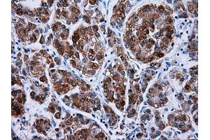 Immunohistochemical staining of paraffin-embedded Carcinoma of liver tissue using anti-HSD17B10mouse monoclonal antibody.
