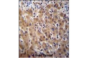 Glypican 3 (GPC3) Antibody (N-term) (ABIN390317 and ABIN2840749) immunohistochemistry analysis in formalin fixed and paraffin embedded human liver tissue followed by peroxidase conjugation of the secondary antibody and DAB staining. (Glypican 3 抗体  (N-Term))