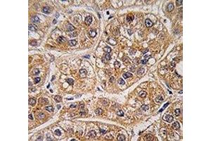 IHC analysis of FFPE human hepatocarcinoma tissue stained with AKR1A1 antibody (AKR1A1 抗体  (AA 293-325))