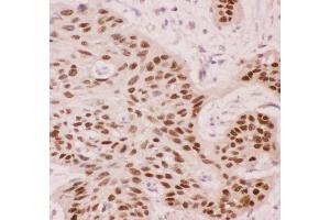 Anti-p63 Picoband antibody,  IHC(P): Human Oesophagus Squama Cancer Tissue (p63 抗体  (AA 311-680))