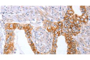 Immunohistochemistry of paraffin-embedded Human cervical cancer tissue using ABO Polyclonal Antibody at dilution 1:50 (ABO 抗体)