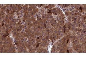 ABIN6277108 at 1/100 staining Human liver cancer tissue by IHC-P. (CD90 抗体  (Internal Region))