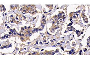 Detection of RIPK1 in Human Breast cancer Tissue using Polyclonal Antibody to Receptor Interacting Serine Threonine Kinase 1 (RIPK1) (RIPK1 抗体  (AA 17-289))