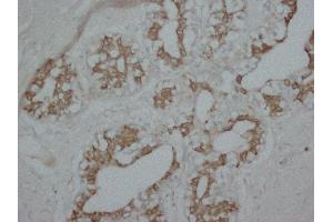Anti-PKC alpha antibody, IHC(P) IHC(P): Human Mammary Cancer Tissue (PKC alpha 抗体  (N-Term))