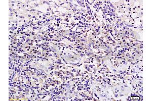 Formalin-fixed and paraffin embedded rat transplant lymphoma labeled with Anti-CD19 Polyclonal Antibody (ABIN724595), Unconjugated 1:200 followed by conjugation to the secondary antibody and DAB staining (CD19 抗体  (AA 485-556))