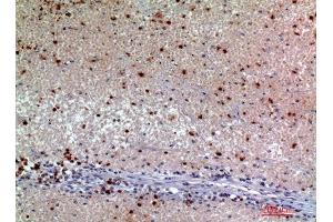 Immunohistochemistry (IHC) analysis of paraffin-embedded Human Kidney Cancer, antibody was diluted at 1:200. (SNCA 抗体)
