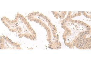 Immunohistochemistry of paraffin-embedded Human thyroid cancer tissue using PBXIP1 Polyclonal Antibody at dilution of 1:40(x200) (PBXIP1 抗体)