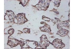 Immunohistochemistry of paraffin-embedded human colon cancer using ABIN7156785 at dilution of 1:100 (IL12B 抗体  (AA 23-328))