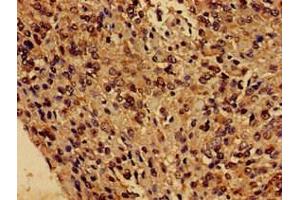 Immunohistochemistry of paraffin-embedded human glioma using ABIN7153243 at dilution of 1:100 (FUNDC1 抗体  (AA 1-46))