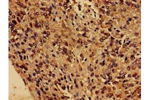 Immunohistochemistry of paraffin-embedded human glioma using ABIN7153243 at dilution of 1:100 (FUNDC1 抗体  (AA 1-46))