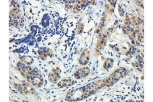 IHC testing of FFPE human breast cancerwith ROR1 antibody at 5ug/ml. (ROR1 抗体)