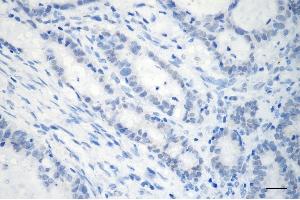 Immunohistochemistry was performed on paraffin-embedded human sigmoid colon carcinoma using GTF2I antibody (ABIN7798709), 1:200). (Recombinant GTF2I 抗体)
