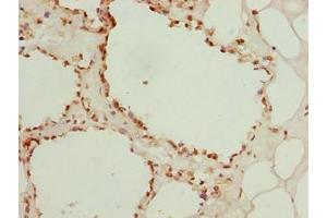 Immunohistochemistry of paraffin-embedded human breast cancer using ABIN7153448 at dilution of 1:100 (LGALS12 抗体  (AA 1-336))