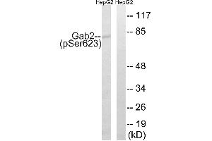 Immunohistochemistry analysis of paraffin-embedded human breast carcinoma tissue using Gab2 (Phospho-Ser623) antibody. (GAB2 抗体  (pSer623))