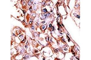 IHC analysis of FFPE human hepatocarcinoma tissue stained with the phospho-HER4 antibody. (ERBB4 抗体  (pTyr1188))