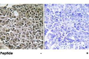 Immunohistochemical analysis of paraffin-embedded human breast carcinoma tissue using NFATC4 polyclonal antibody . (NFATC4 抗体)